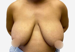 Breast Lift