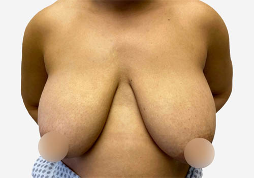 Breast Lift
