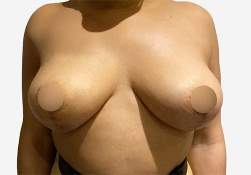 Breast Lift