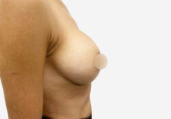 Breast Augmentation