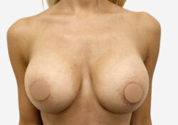 Breast Augmentation