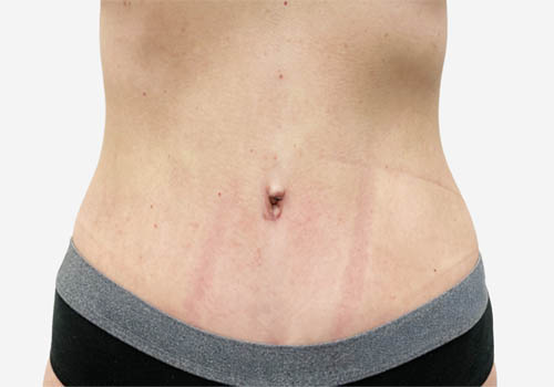 Tummy Tuck