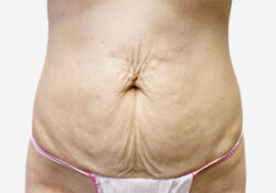 Tummy Tuck