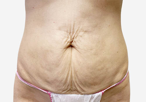 Tummy Tuck