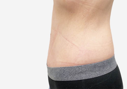 Tummy Tuck