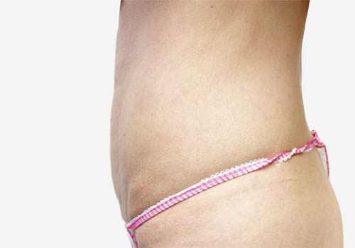 Tummy Tuck