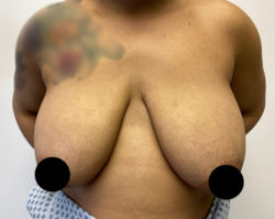 Breast Lift