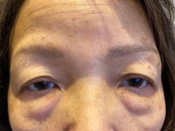 Eyelid Surgery