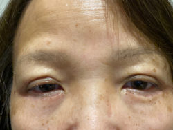 Eyelid Surgery