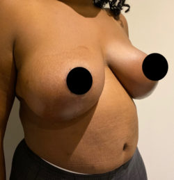 Breast Reduction