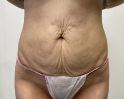 Tummy Tuck