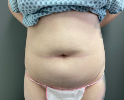 Liposuction