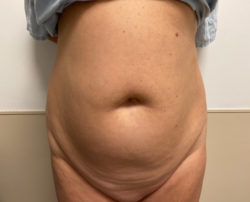 Tummy Tuck