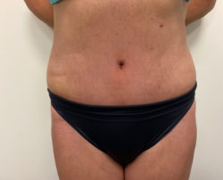 Tummy Tuck