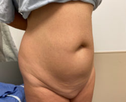 Tummy Tuck