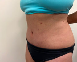 Tummy Tuck