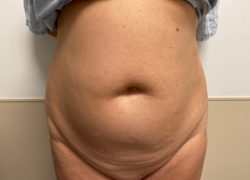 Tummy Tuck