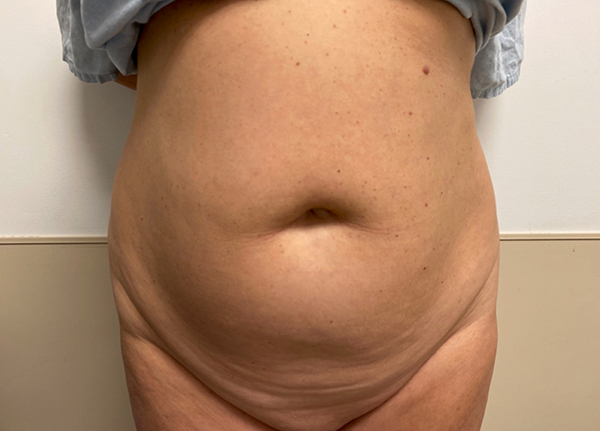 Tummy Tuck Case 2717 Before Photo Tummy Tuck