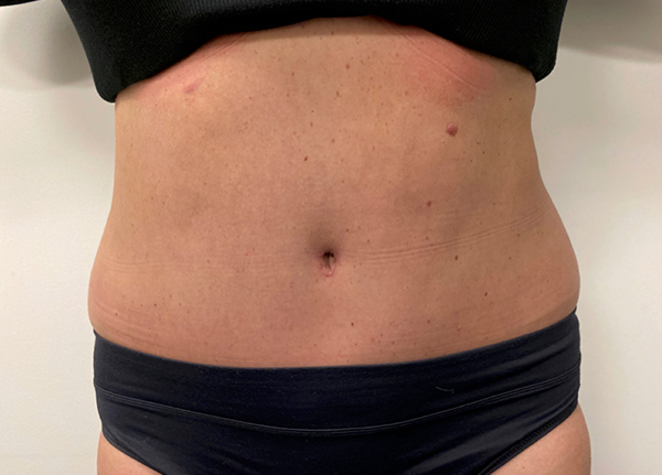Tummy Tuck Case 2717 After Photo Tummy Tuck