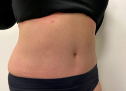 Tummy Tuck