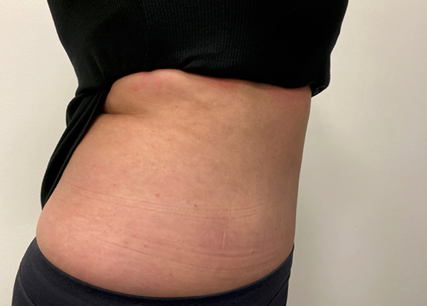 Tummy Tuck