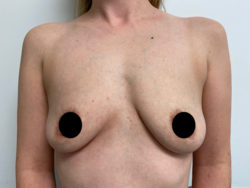 Breast Augmentation