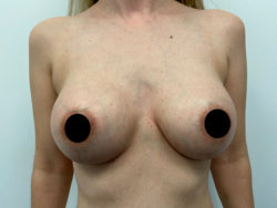 Breast Augmentation