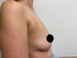 Breast Augmentation