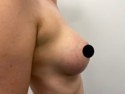 Breast Augmentation