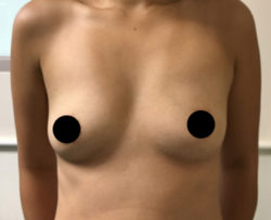 Breast Augmentation