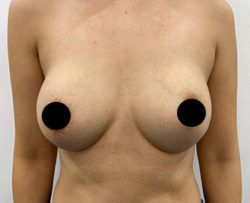 Breast Augmentation