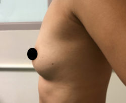 Breast Augmentation