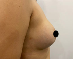 Breast Augmentation