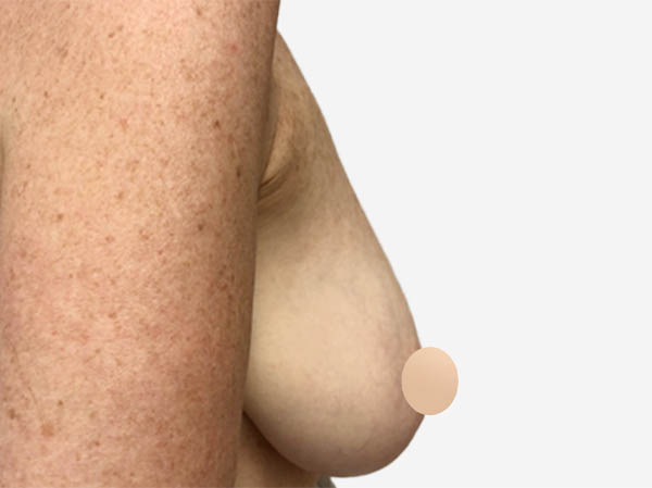 Breast Reconstruction