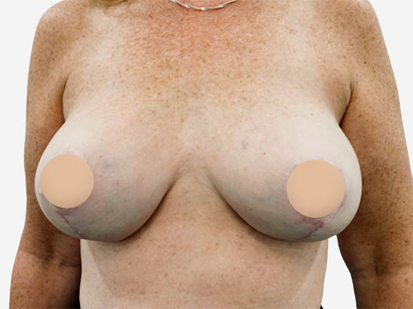 Breast Reconstruction