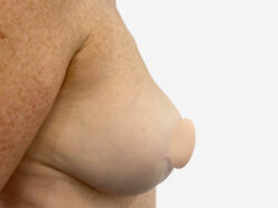 Breast Reconstruction