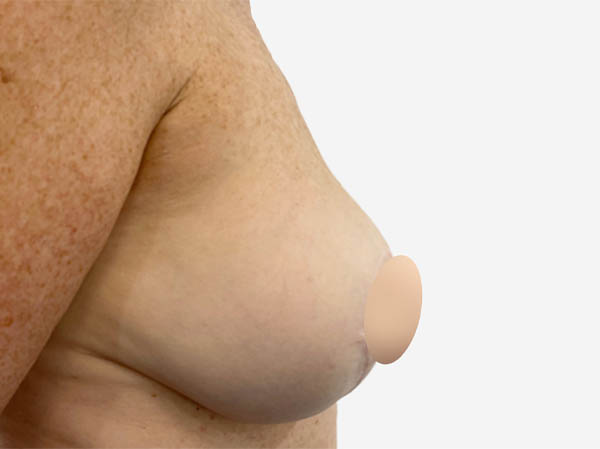 Breast Reconstruction