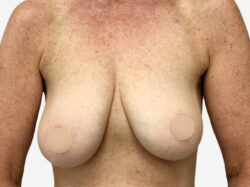 Breast Reconstruction