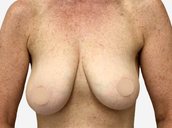 Breast Reconstruction