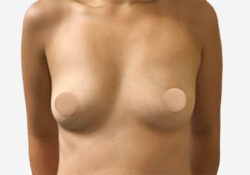 Breast Augmentation