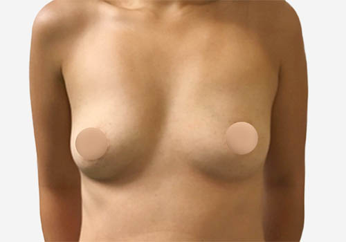Breast Augmentation