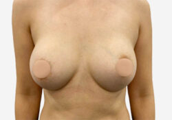 Breast Augmentation