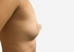 Breast Augmentation