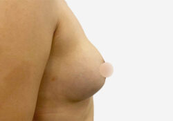 Breast Augmentation