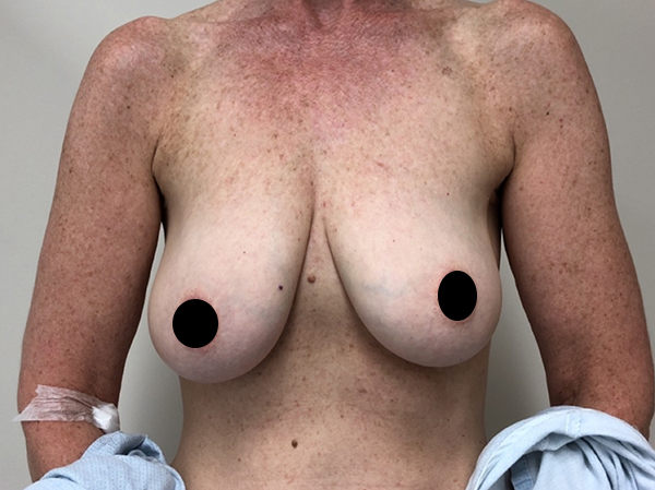 Toronto Breast Reconstruction before and after photos