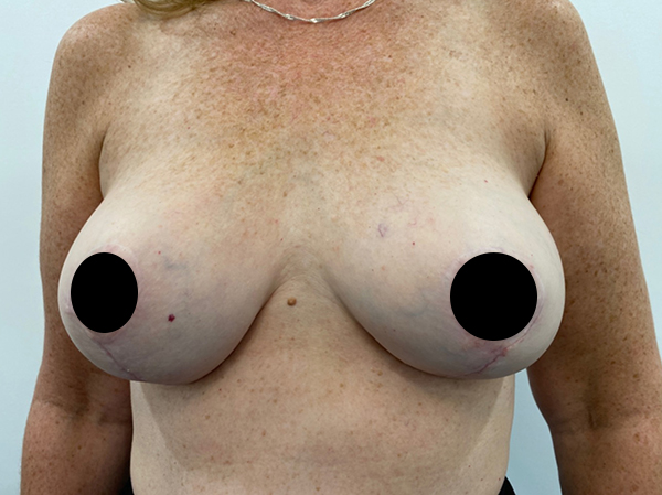 Toronto Breast Reconstruction before and after photos