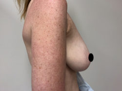 Breast Reconstruction