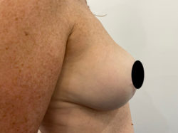 Breast Reconstruction