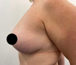 Breast Lift