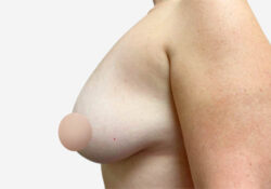 Breast Lift
